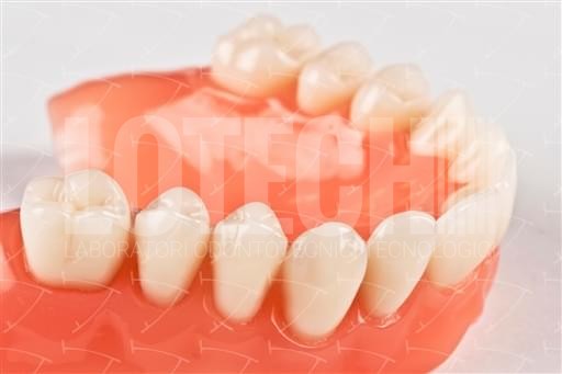 Laboratorio Odontotecnico Brescia - 4U-8d53-a – Protesi totale in resina  acrilica con denti del commercio in ceramica